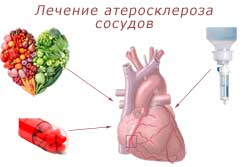 Диета При Атеросклерозе Сосудов Сердца