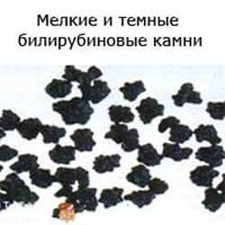билирубиновый состав желчных камней