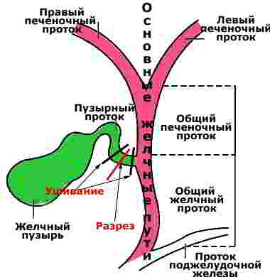 операция удаления желчного пузыря