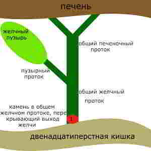 Камень вклинился в общий желчный проток и перекрыл выход желчи