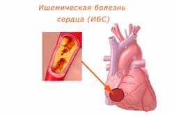 ишемическая болезнь сердца - поражение артерии сердца