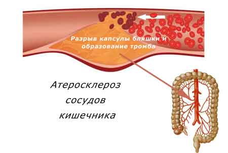 атеросклероз сосудов кишечника