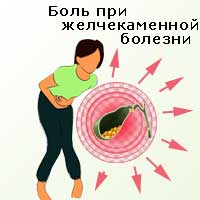 боль при желчекаменной болезни