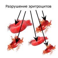 третья причина анемий - повышенное разрушение эритроцитов