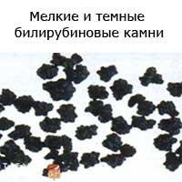 мелкие и темные билирубиновые камни