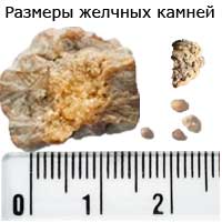 размеры желчных камней