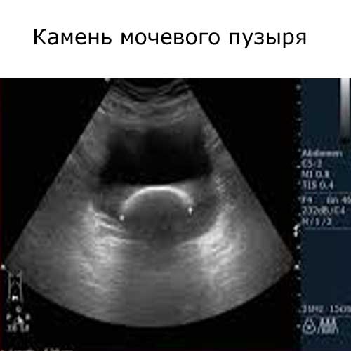 камень мочевого пузыря на УЗИ