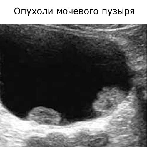 две опухоли мочевого пузыря на УЗИ