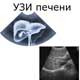 УЗИ печени
