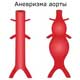 аневризма аорты
