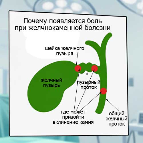 доктор показывает, где может застрять желчный камень