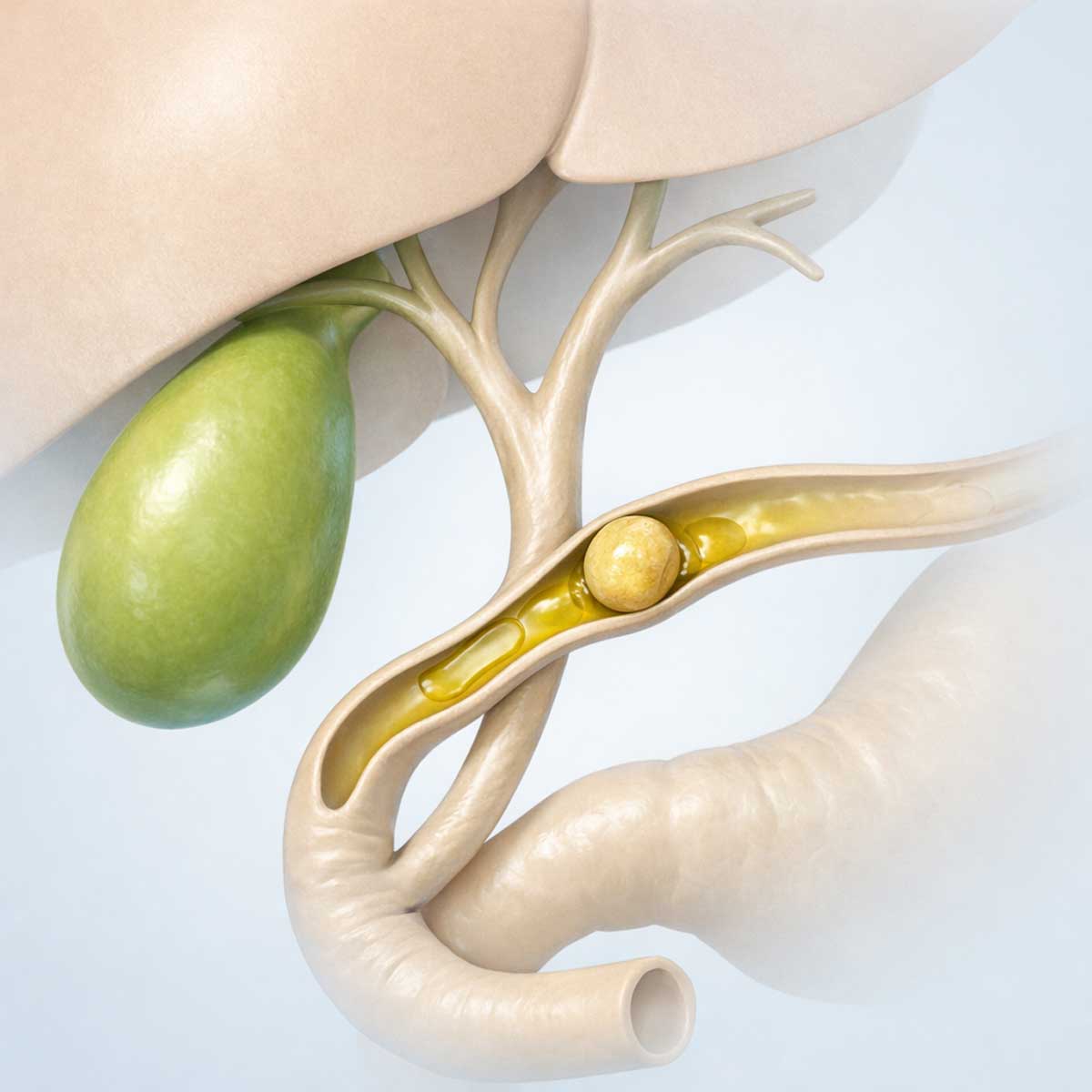 Медицинская 3D-иллюстрация печеночной колики при желчнокаменной болезни: желчный пузырь и желчные протоки с временным нарушением оттока желчи.