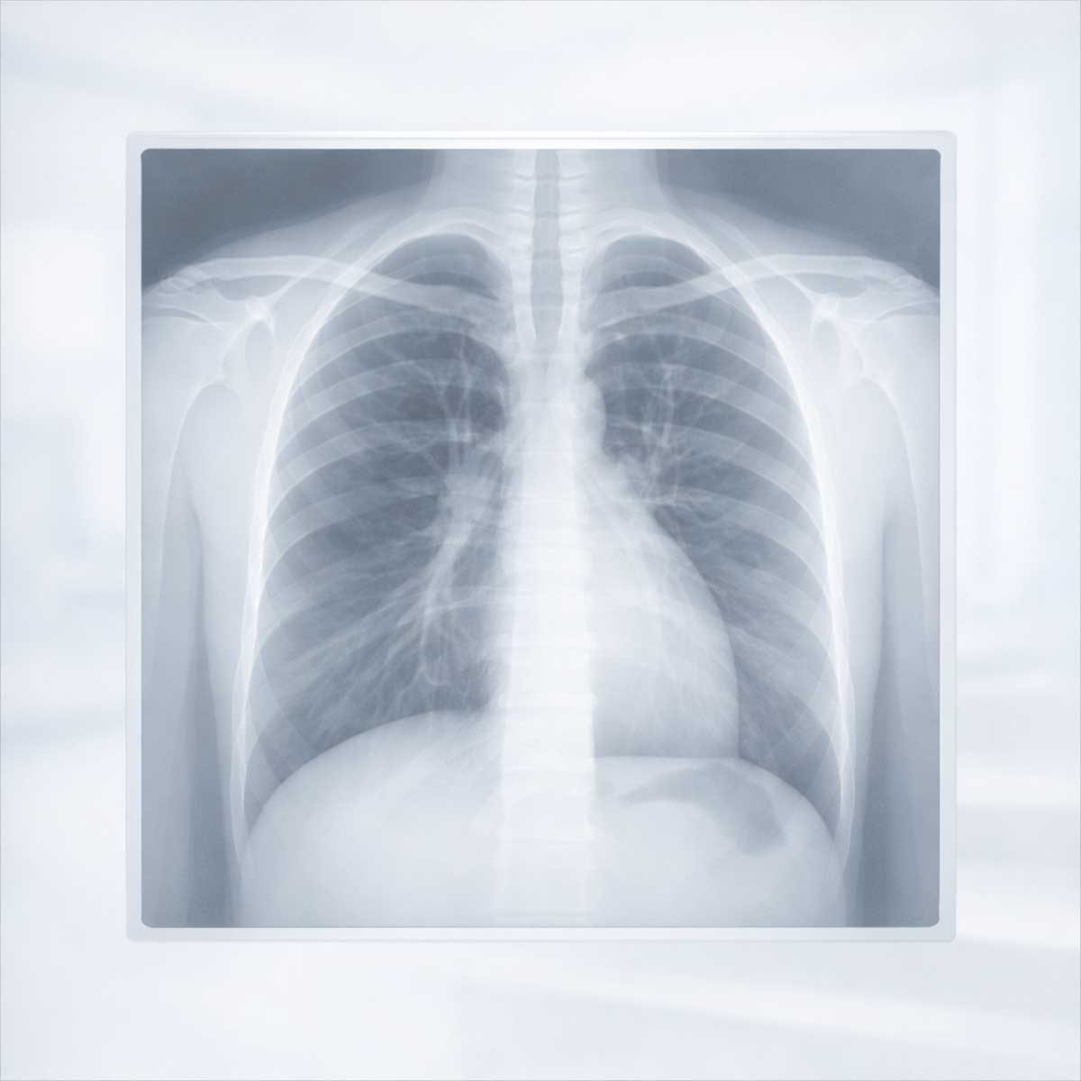 Что показывает рентген легких Что видно на рентгене легких — основные структуры органов грудной клетки