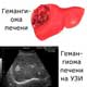 гемангиома печени