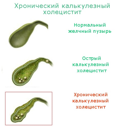 Острый калькулезный холецистит презентация