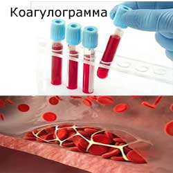 коагулограмма