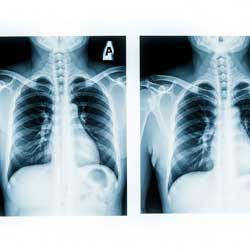рентгенограмма грудной клетки