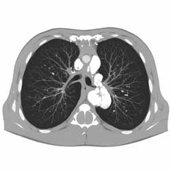 компьютерная томография легких