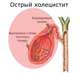острый холецистит