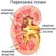 паренхима почки