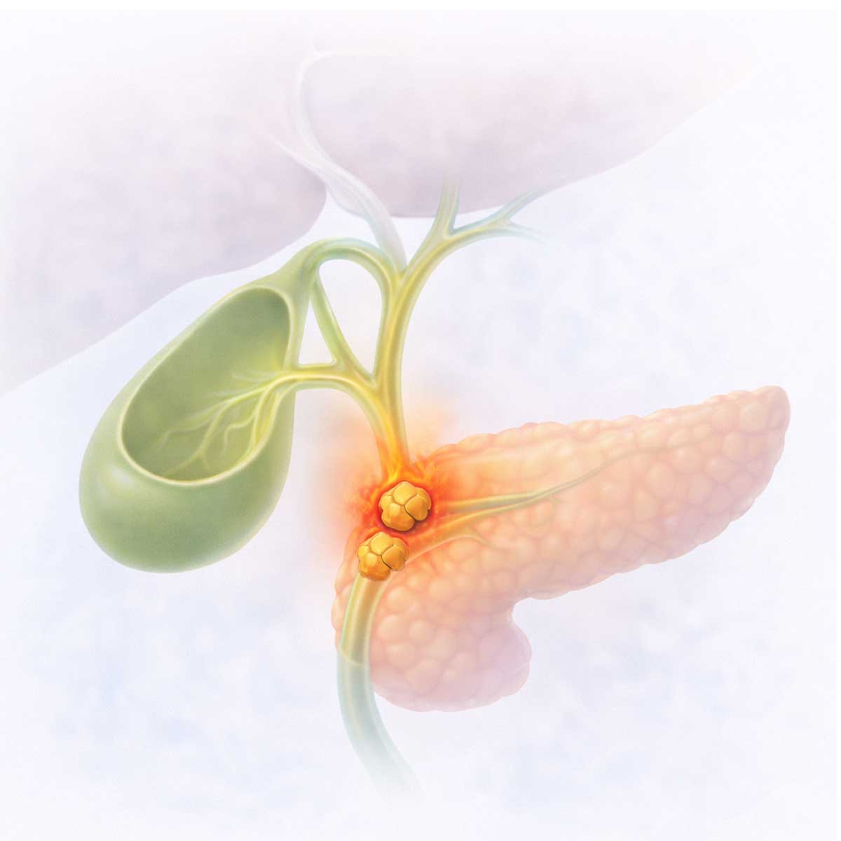 Билиарный панкреатит при желчнокаменной болезни: нарушение оттока желчи и вовлечение поджелудочной железы