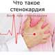 что такое стенокардия